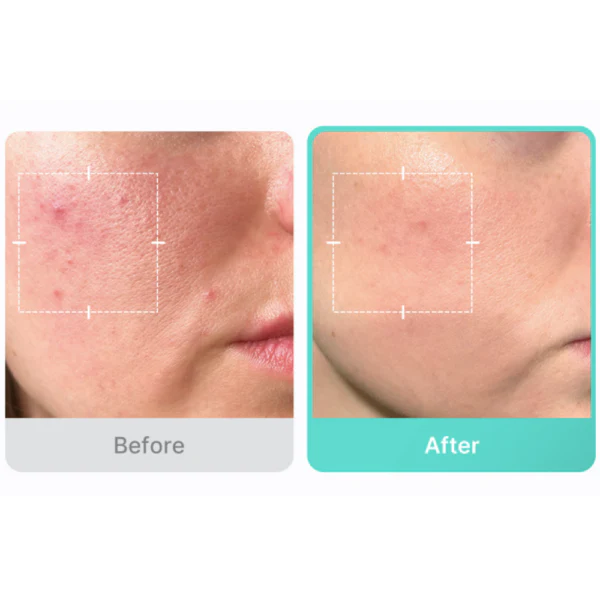 Azelaic Acid 16 BB Soothing Serum 2.0 Medicube